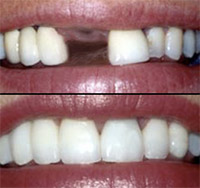 dental_implant_0.9944031.JPEG