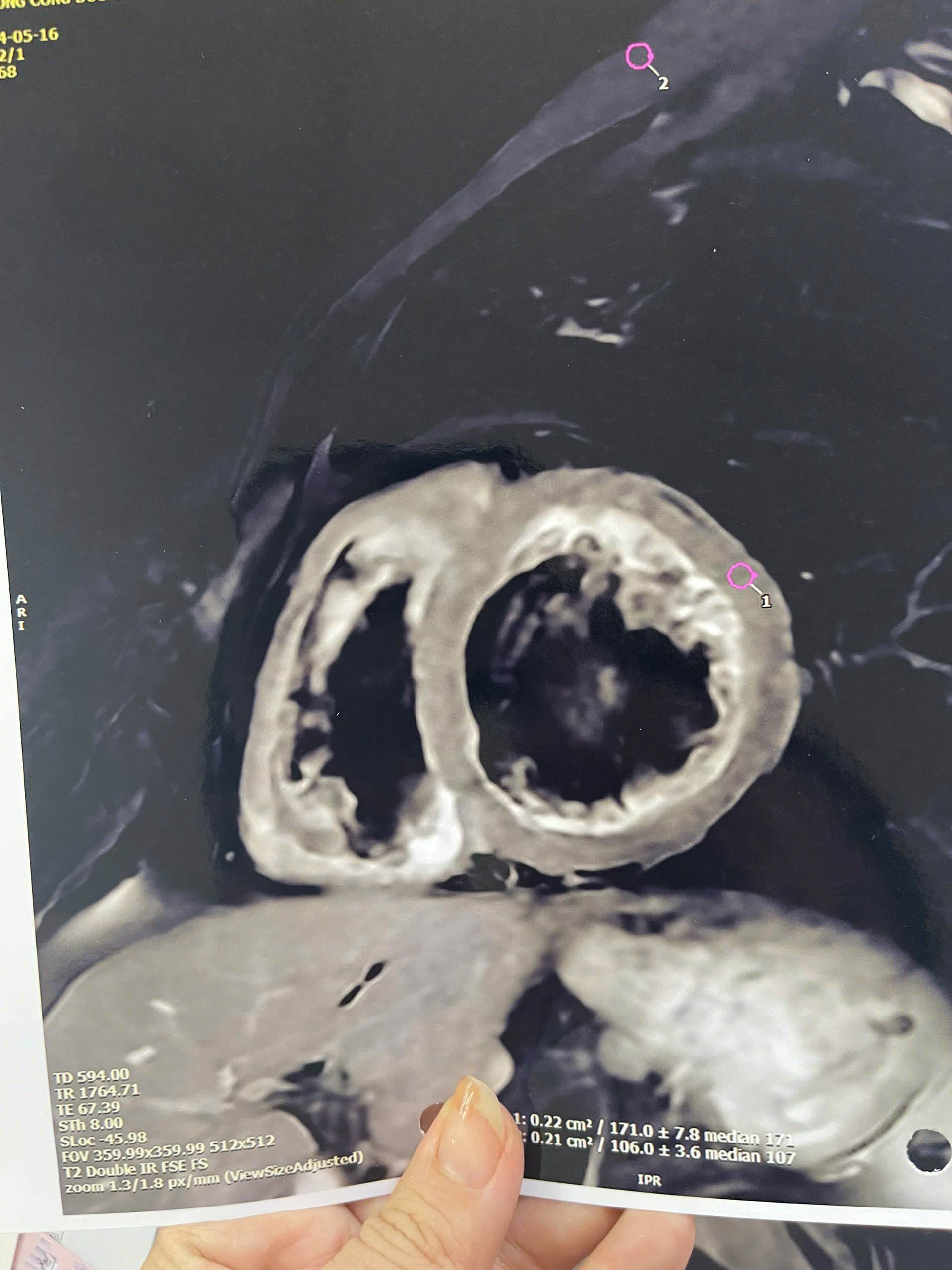 Heart Failure CT scan