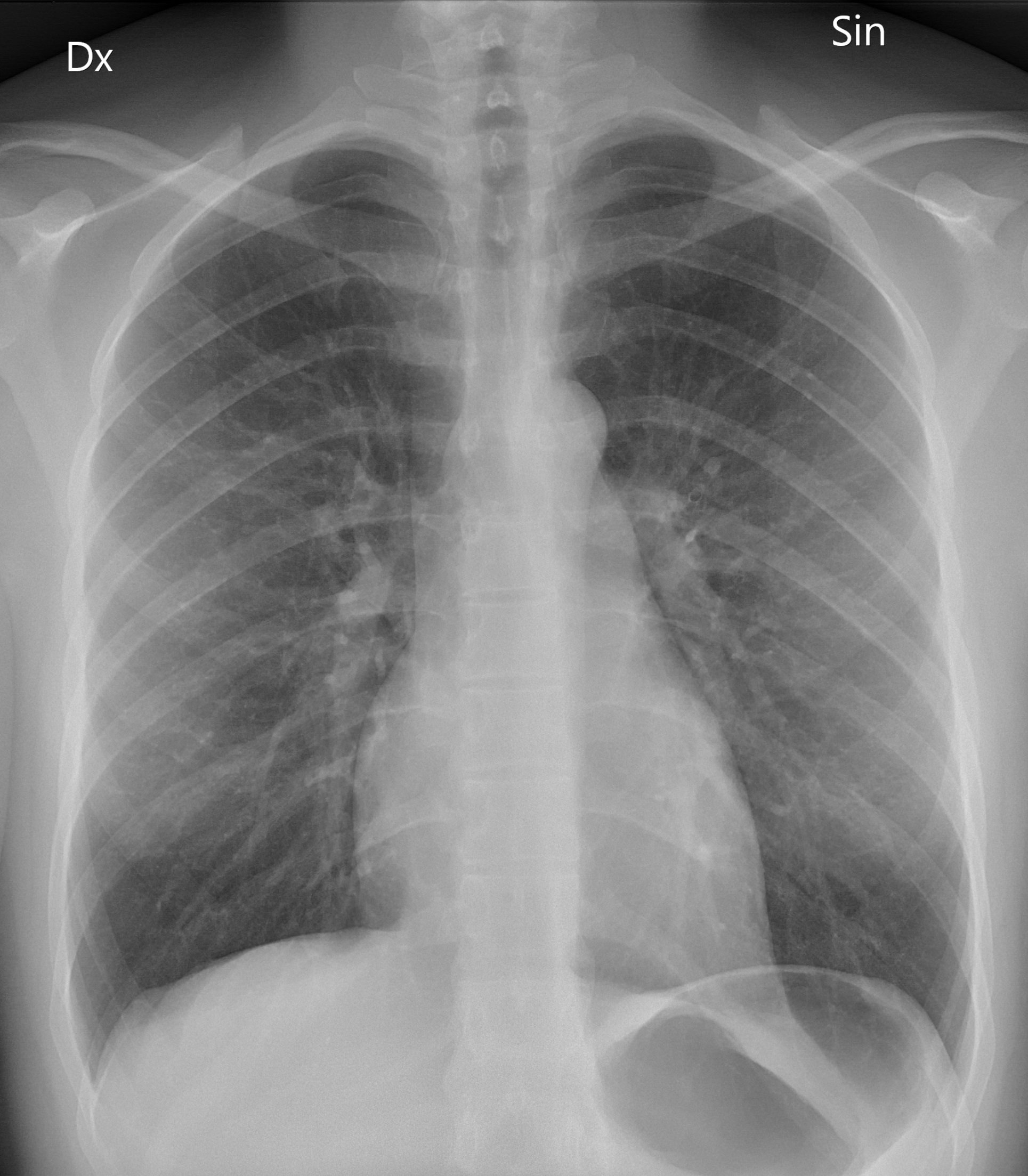 chest_X-ray.jpg