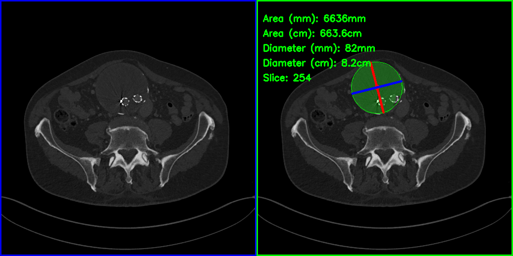 aortic_aneurysm_example.png