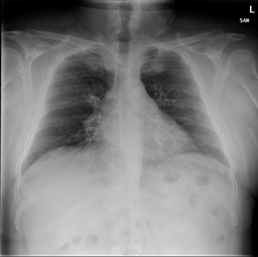 Jyothirmai/image-captioning-chest-xrays at main