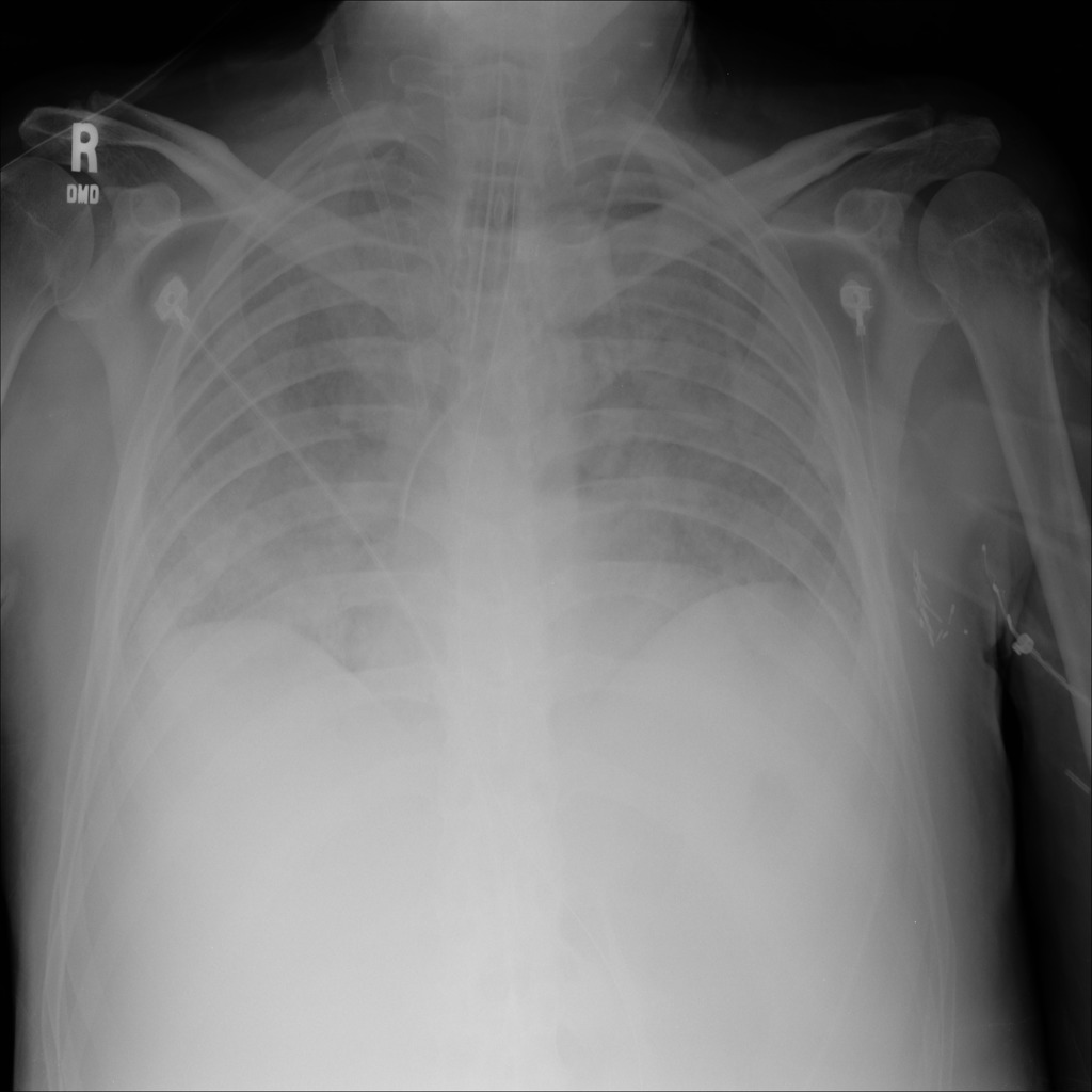 xray_pneumonia.png