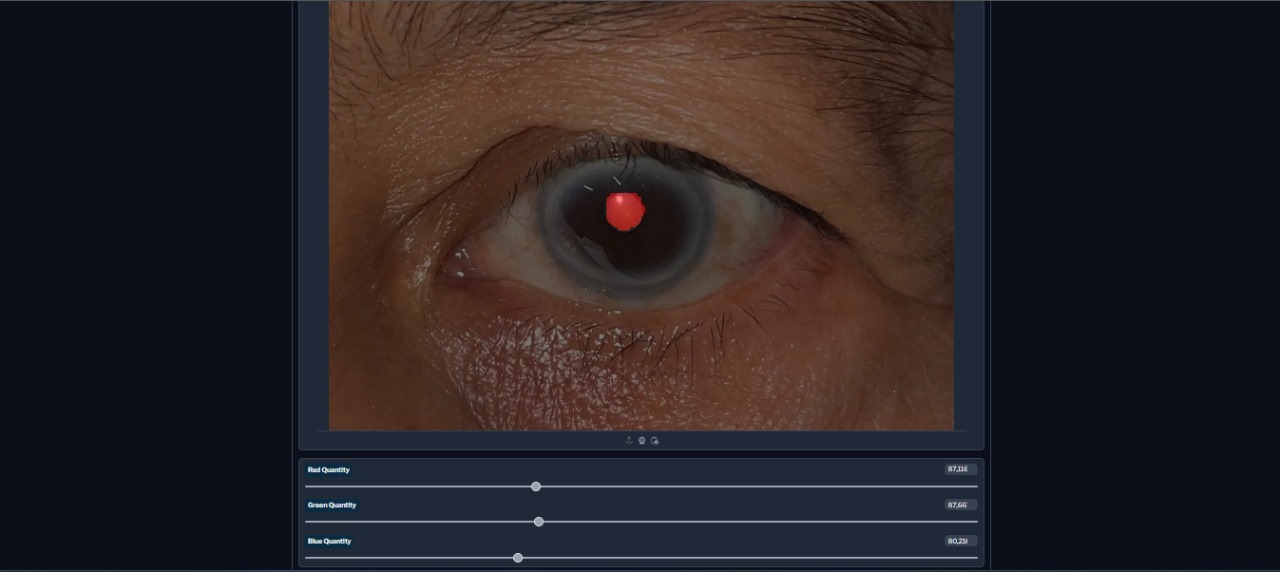 Cataract Analyzer