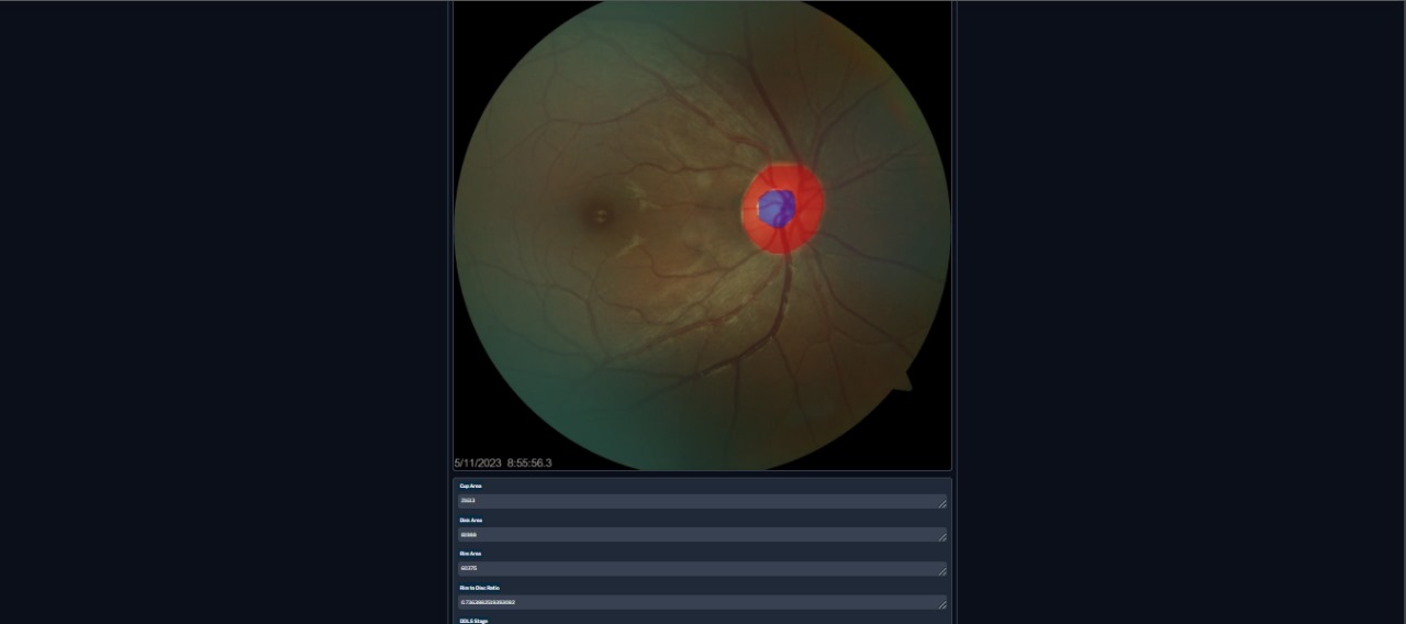 Glaucoma Analyzer