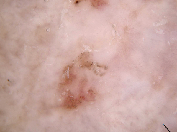 squamous cell carcinoma.jpg