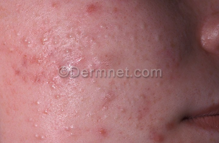 acne-closed-comedo-2.jpg
