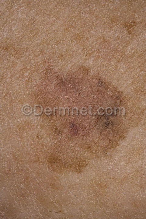malignant-melanoma-16.jpg