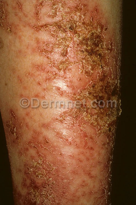 eczema-asteatotic-37.jpg