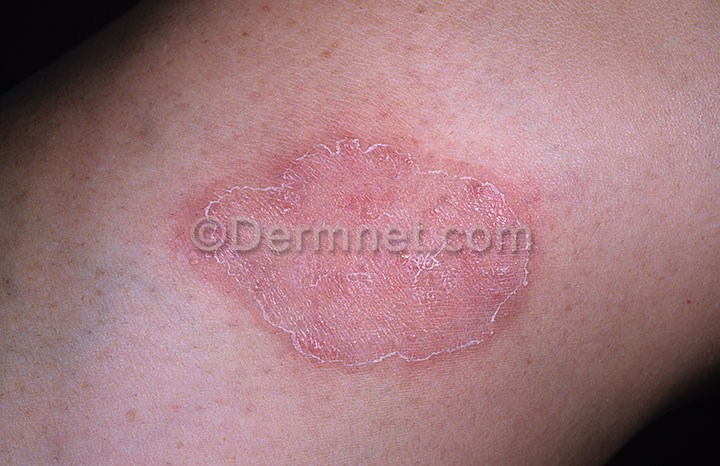 tinea-primary-lesion-15.jpg