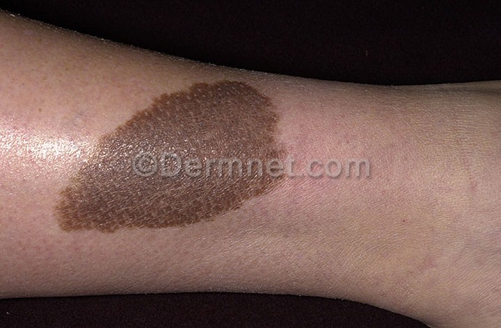 congenital-nevus-35.jpg