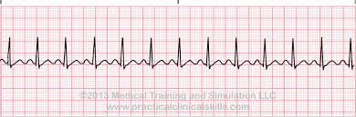 tachycardia ECG.jpg