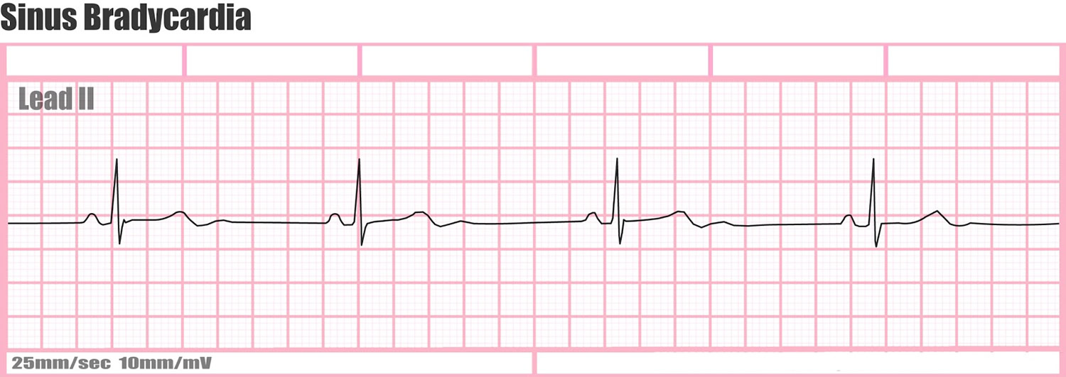 bradycardia-ECG.jpg