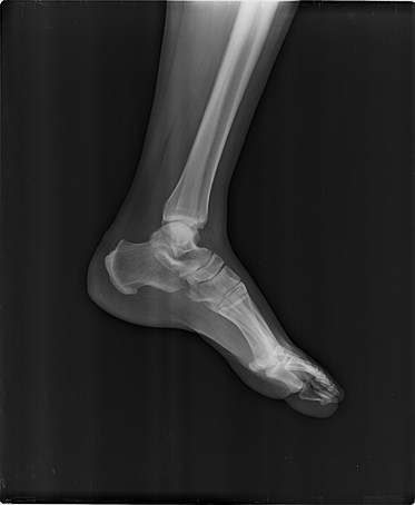 Foot_Not_Fractured.jpg