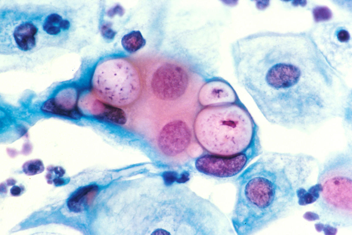 1200px-Pap_smear_showing_clamydia_in_the_vacuoles_500x_H&E.jpg